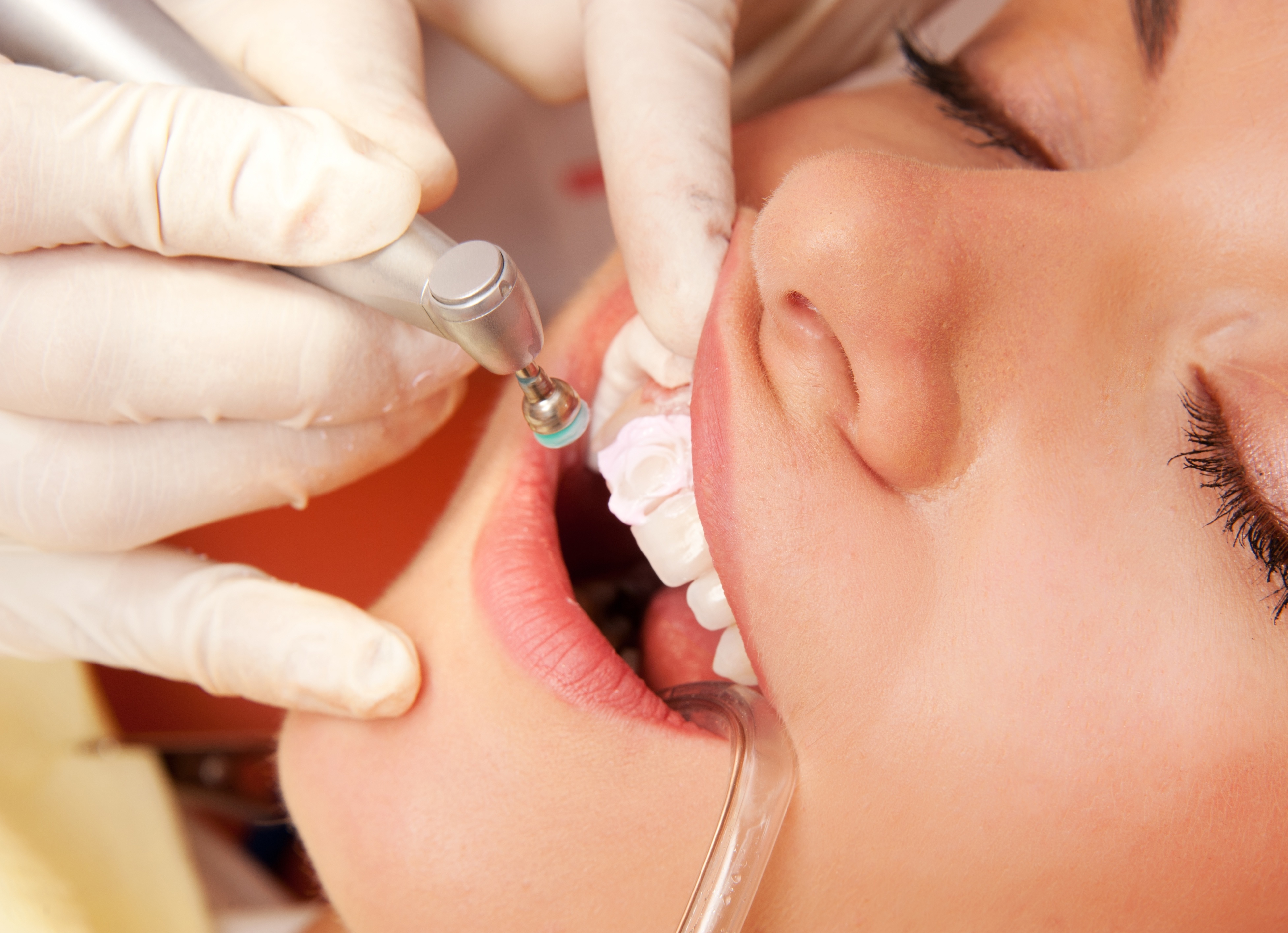 Teeth Whitening In Castle Hill: Benefits